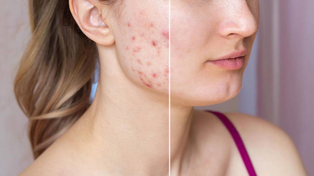 Acne Treatment Dermatologist in Barrie