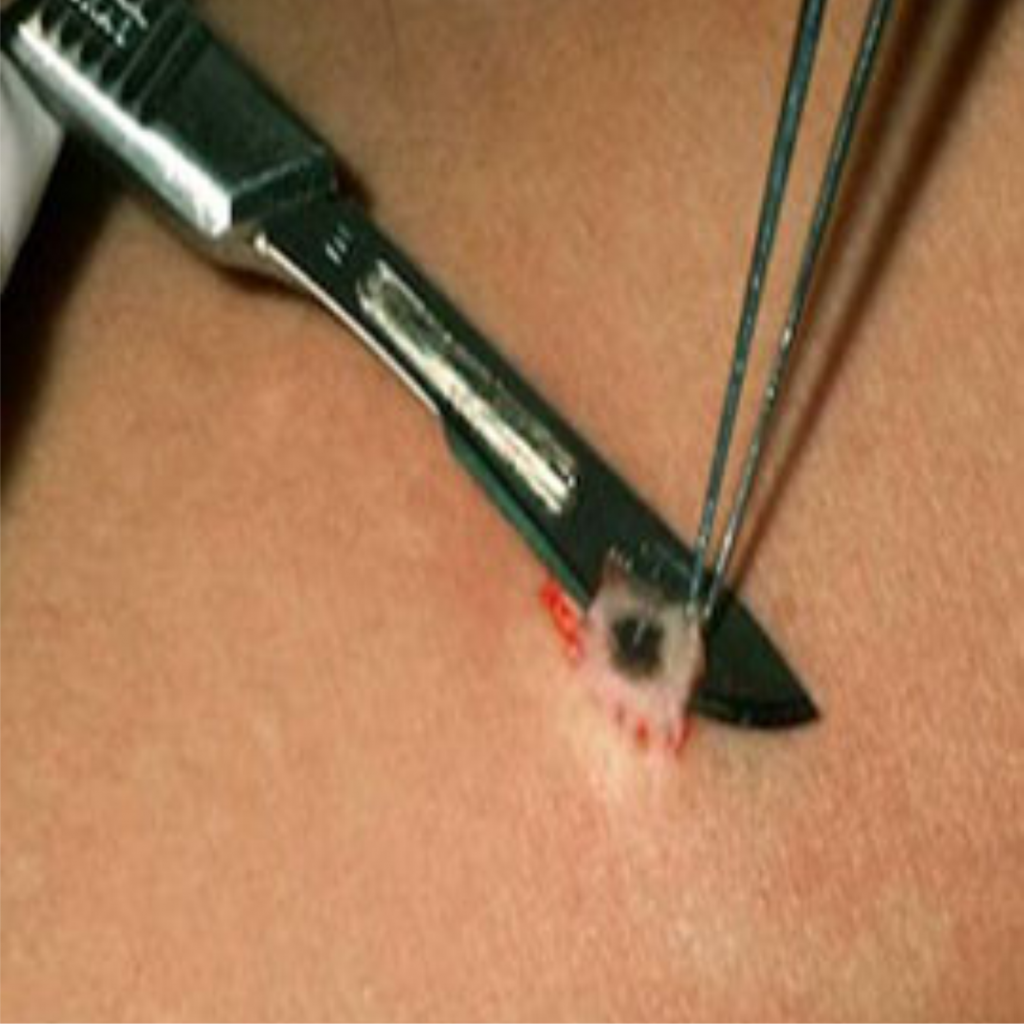 treatment of skin in barrie -Biopsy
