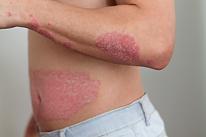 psoriasis clinical trials Barrie