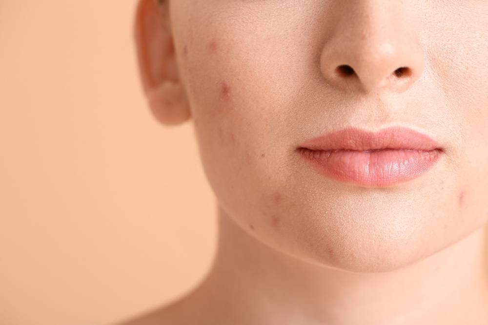 young
woman acne