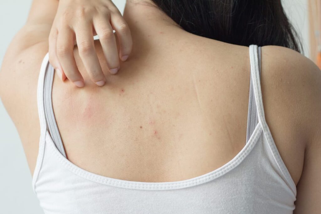 body acne treatment | skin treatment Barrie