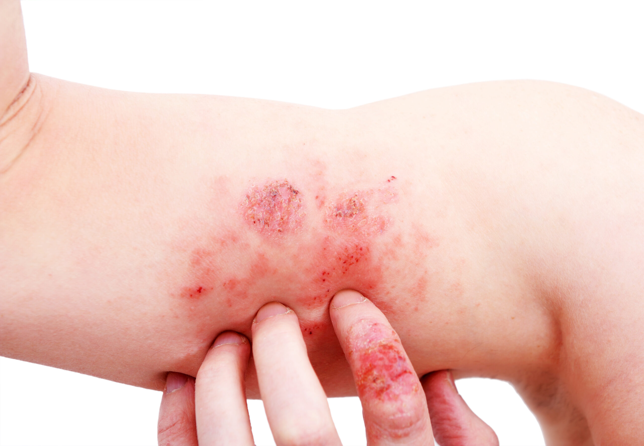 Atopic Dermatitis (Eczema) Treatment