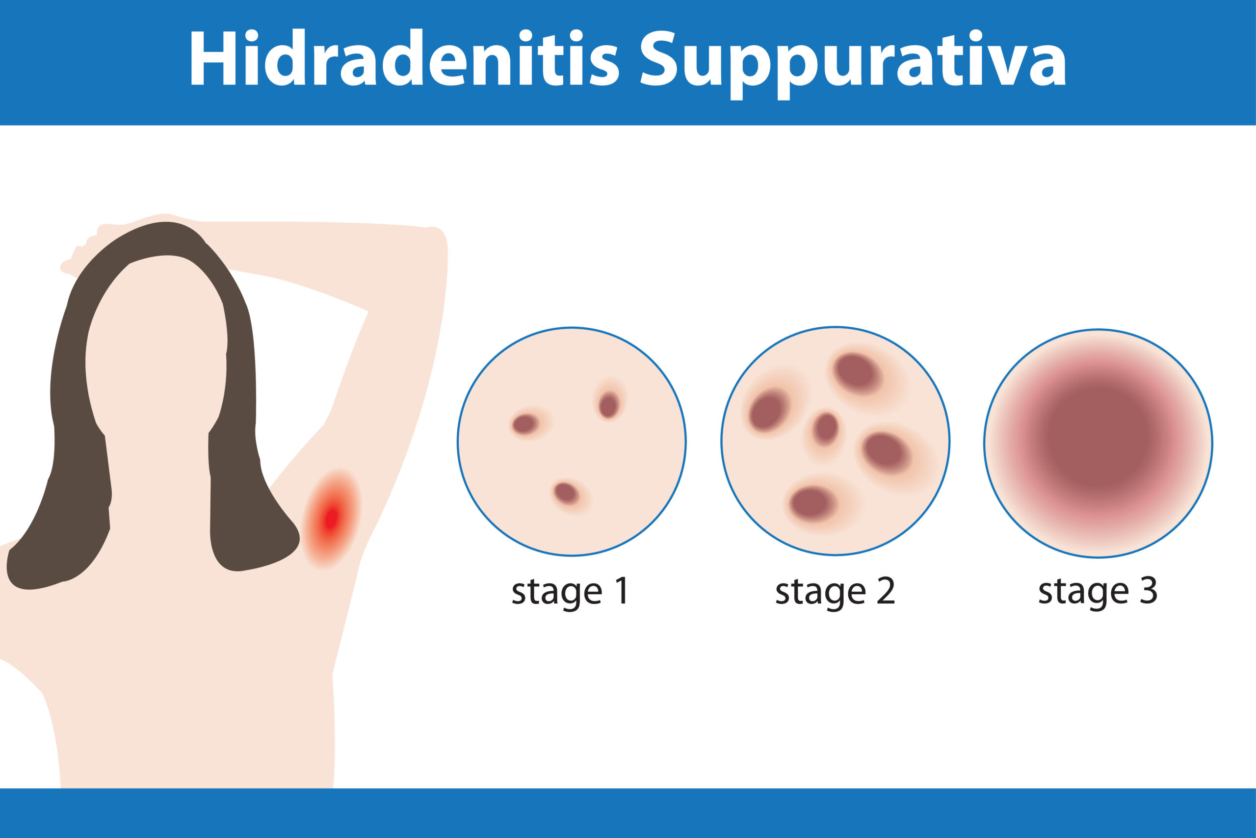 Hidradenitis Suppurativa Treatment