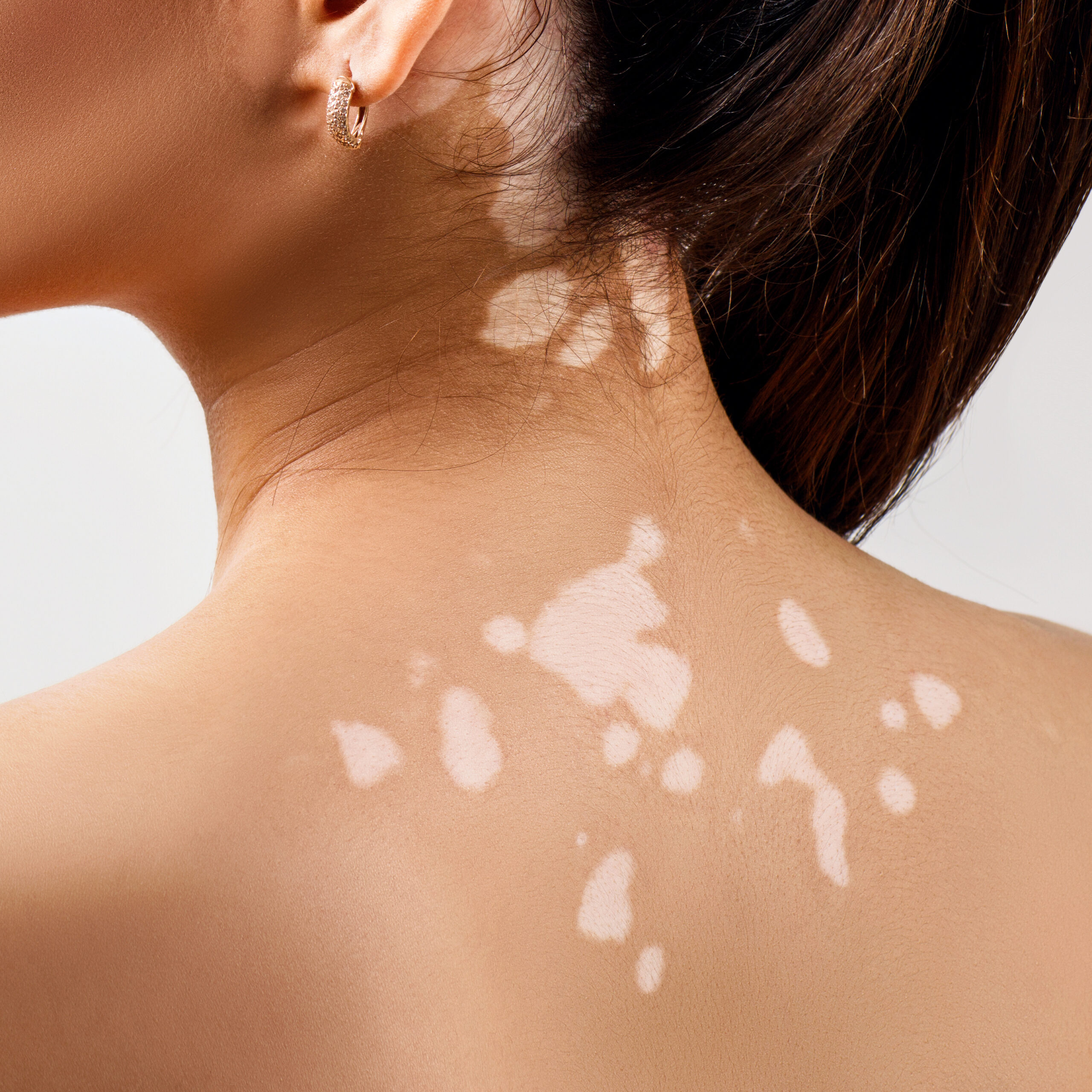 Vitiligo on a person's upper back