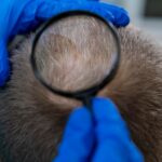 Cancerous Mole on Scalp