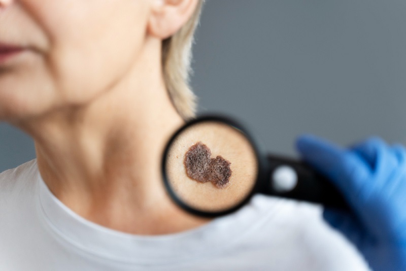 Mole Check Dermatologist in Barrie