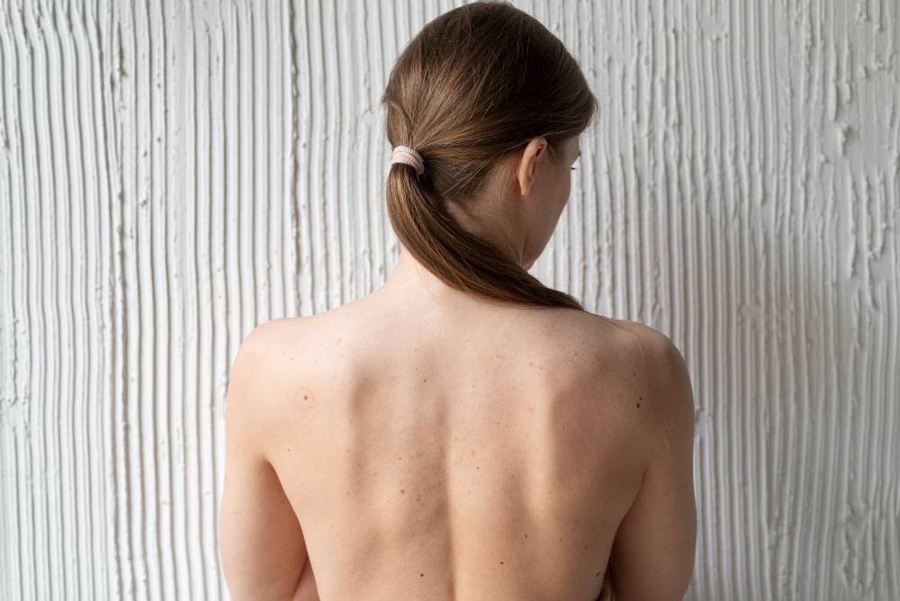Causes Back Acne