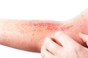 An atopic dermatitis rash on a person's arm