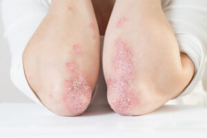 Dry skin from Eczema