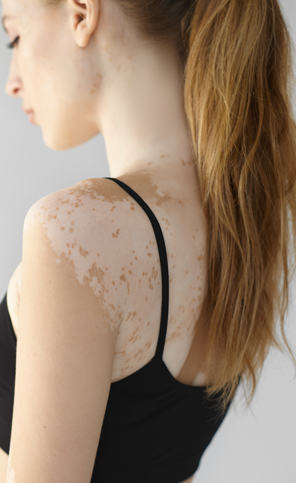 Vitiligo patches on a woman's back