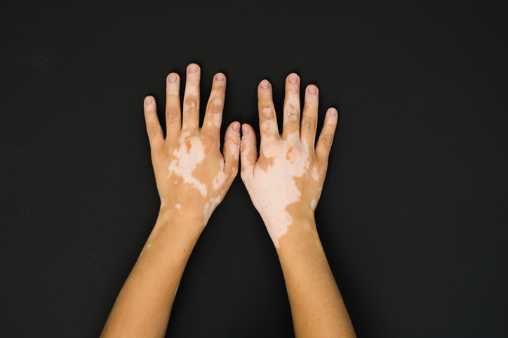 Vitiligo on a person's hands