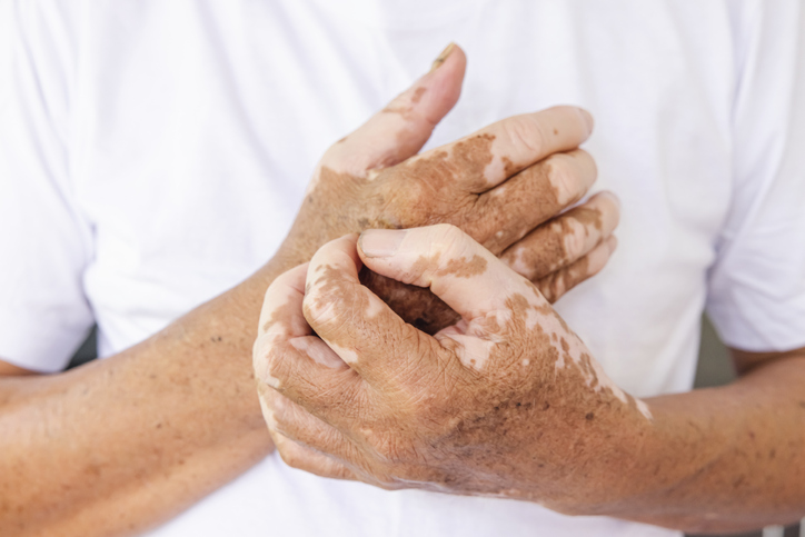 Close-up Vitiligo on skin hands