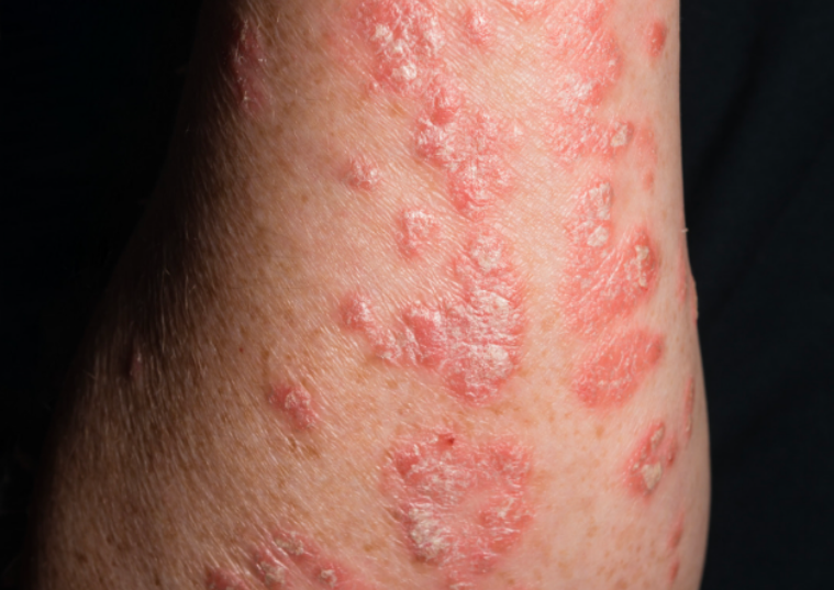 Plaque Psoriasis on a person's arm
