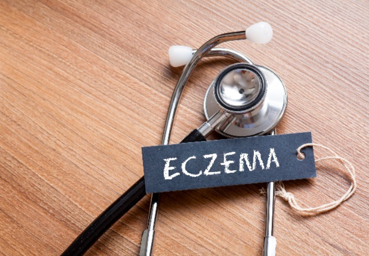 Eczema in healthcare image