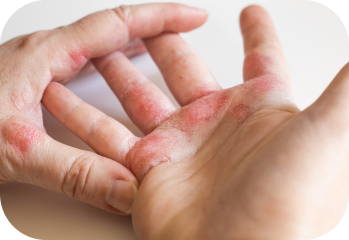 Hands with Eczema