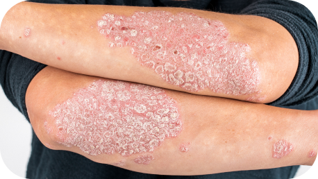 Psoriasis on a person's arm