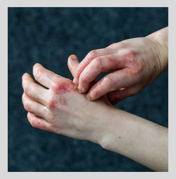 Eczema on a person's hands