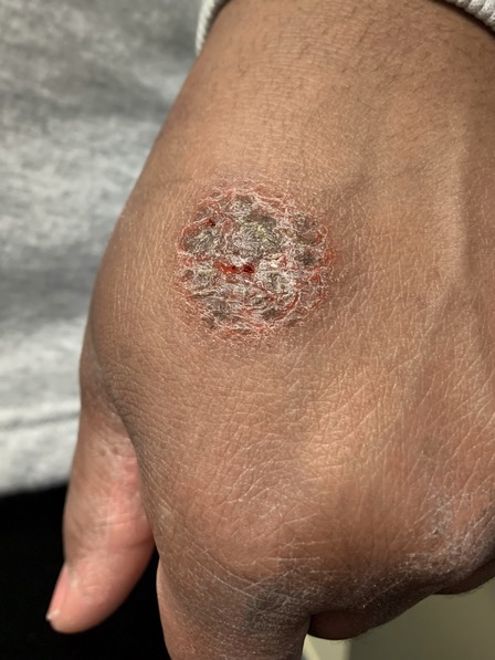 Nummular dermatitis on a person's hand