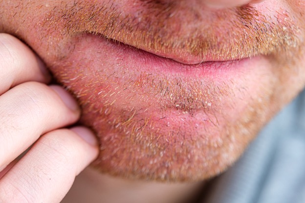 seborrheic dermatitis on a man's face