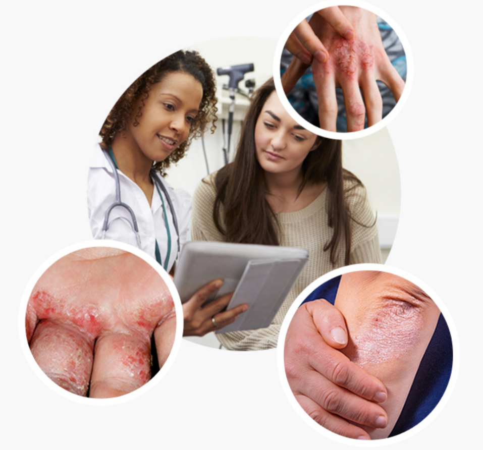 Eczema Clinical Trial Image