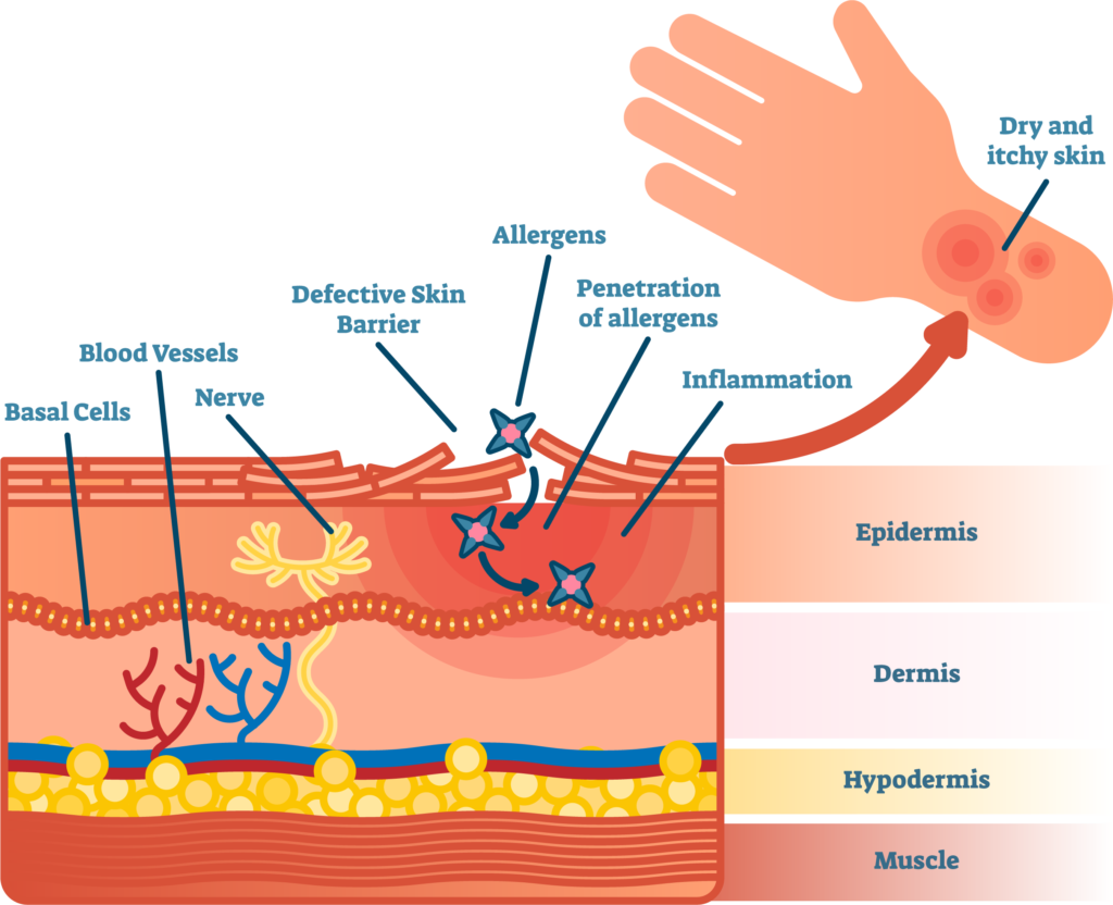 The skin barrier and eczema
